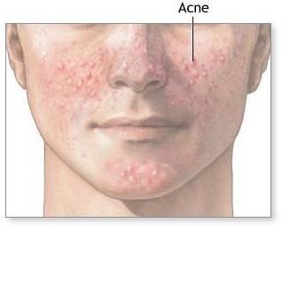 acne ok.jpg